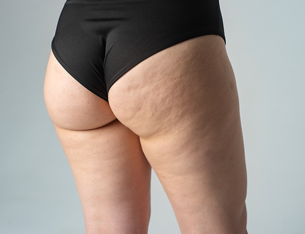lipedema-land lipedema