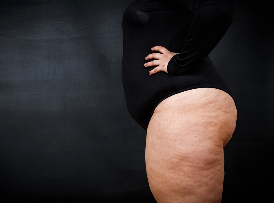 lipedema3